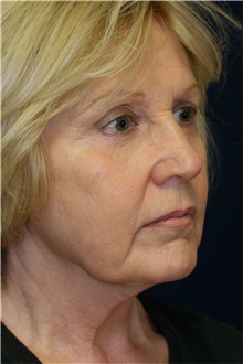 Facelift Before Photo by Steve Laverson, MD, FACS; Rancho Santa Fe, CA - Case 42665