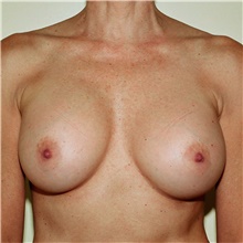Breast Augmentation After Photo by Steve Laverson, MD, FACS; Rancho Santa Fe, CA - Case 42710