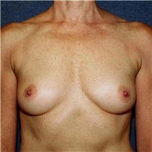 Breast Augmentation Before Photo by Steve Laverson, MD, FACS; San Diego, CA - Case 42710
