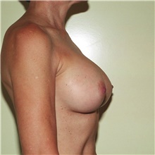 Breast Augmentation After Photo by Steve Laverson, MD, FACS; Rancho Santa Fe, CA - Case 42710