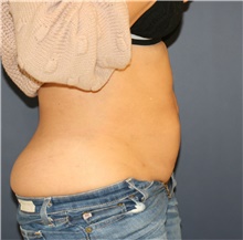 Tummy Tuck Before Photo by Steve Laverson, MD, FACS; Rancho Santa Fe, CA - Case 43029