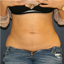 Tummy Tuck Before Photo by Steve Laverson, MD, FACS; Rancho Santa Fe, CA - Case 43029