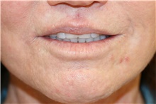 Lip Augmentation/Enhancement After Photo by Steve Laverson, MD, FACS; San Diego, CA - Case 43079