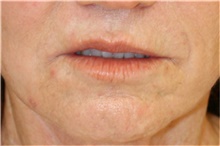 Lip Augmentation/Enhancement Before Photo by Steve Laverson, MD, FACS; Rancho Santa Fe, CA - Case 43079