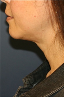 Liposuction After Photo by Steve Laverson, MD, FACS; Rancho Santa Fe, CA - Case 43116