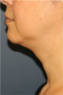 Liposuction Before Photo by Steve Laverson, MD, FACS; San Diego, CA - Case 43116