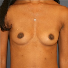 Breast Augmentation Before Photo by Steve Laverson, MD, FACS; Rancho Santa Fe, CA - Case 43128