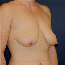 Breast Lift Before Photo by Steve Laverson, MD, FACS; Rancho Santa Fe, CA - Case 43134