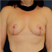 Breast Lift After Photo by Steve Laverson, MD, FACS; Rancho Santa Fe, CA - Case 43134