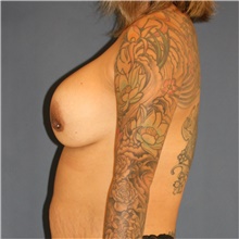 Breast Implant Revision After Photo by Steve Laverson, MD, FACS; Rancho Santa Fe, CA - Case 43135