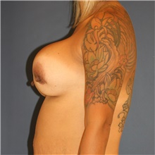 Breast Implant Revision Before Photo by Steve Laverson, MD, FACS; Rancho Santa Fe, CA - Case 43135