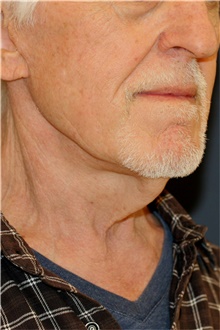 Neck Lift Before Photo by Steve Laverson, MD, FACS; Rancho Santa Fe, CA - Case 43144