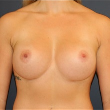 Breast Augmentation After Photo by Steve Laverson, MD, FACS; Rancho Santa Fe, CA - Case 43587
