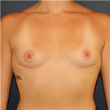 Breast Augmentation Before Photo by Steve Laverson, MD, FACS; Rancho Santa Fe, CA - Case 43587