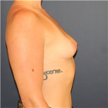 Breast Augmentation Before Photo by Steve Laverson, MD, FACS; Rancho Santa Fe, CA - Case 43587