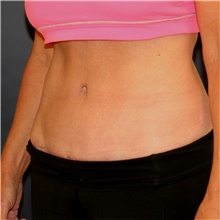 Tummy Tuck After Photo by Steve Laverson, MD, FACS; Rancho Santa Fe, CA - Case 43599