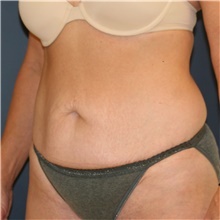 Tummy Tuck Before Photo by Steve Laverson, MD, FACS; Rancho Santa Fe, CA - Case 43599