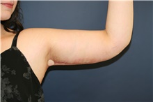 Arm Lift After Photo by Steve Laverson, MD, FACS; San Diego, CA - Case 43731