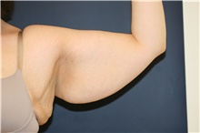 Arm Lift Before Photo by Steve Laverson, MD, FACS; Rancho Santa Fe, CA - Case 43731