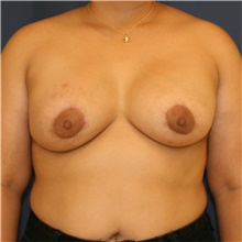 Breast Lift After Photo by Steve Laverson, MD, FACS; Rancho Santa Fe, CA - Case 43961