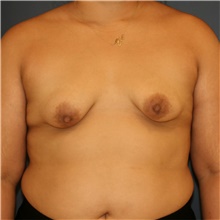 Breast Lift Before Photo by Steve Laverson, MD, FACS; Rancho Santa Fe, CA - Case 43961