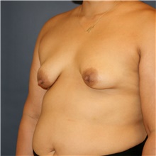 Breast Lift Before Photo by Steve Laverson, MD, FACS; Rancho Santa Fe, CA - Case 43961