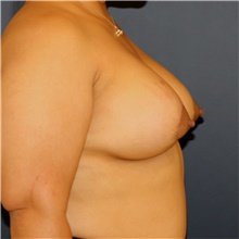 Breast Lift After Photo by Steve Laverson, MD, FACS; Rancho Santa Fe, CA - Case 43961