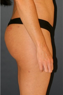 Buttock Lift with Augmentation After Photo by Steve Laverson, MD, FACS; San Diego, CA - Case 44188