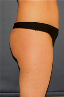 Buttock Lift with Augmentation Before Photo by Steve Laverson, MD, FACS; San Diego, CA - Case 44188