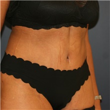 Tummy Tuck After Photo by Steve Laverson, MD, FACS; Rancho Santa Fe, CA - Case 44200