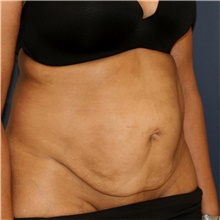 Tummy Tuck Before Photo by Steve Laverson, MD, FACS; Rancho Santa Fe, CA - Case 44200