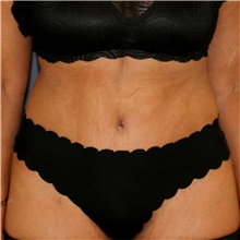 Tummy Tuck After Photo by Steve Laverson, MD, FACS; Rancho Santa Fe, CA - Case 44200