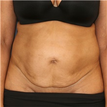 Tummy Tuck Before Photo by Steve Laverson, MD, FACS; Rancho Santa Fe, CA - Case 44200