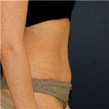 Tummy Tuck After Photo by Steve Laverson, MD, FACS; Rancho Santa Fe, CA - Case 44303