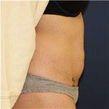 Tummy Tuck Before Photo by Steve Laverson, MD, FACS; Rancho Santa Fe, CA - Case 44303