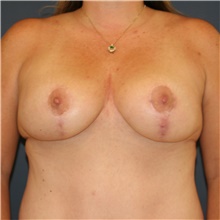 Breast Lift After Photo by Steve Laverson, MD, FACS; Rancho Santa Fe, CA - Case 44320