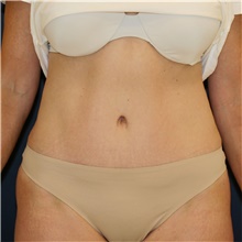 Tummy Tuck After Photo by Steve Laverson, MD, FACS; Rancho Santa Fe, CA - Case 44325