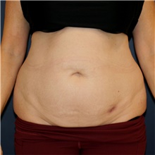 Tummy Tuck Before Photo by Steve Laverson, MD, FACS; Rancho Santa Fe, CA - Case 44325