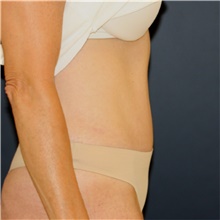 Tummy Tuck After Photo by Steve Laverson, MD, FACS; Rancho Santa Fe, CA - Case 44325