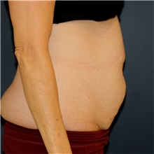 Tummy Tuck Before Photo by Steve Laverson, MD, FACS; Rancho Santa Fe, CA - Case 44325