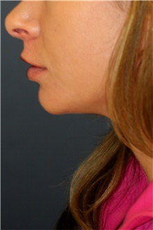 Chin Augmentation Before Photo by Steve Laverson, MD, FACS; Rancho Santa Fe, CA - Case 44369