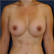 Breast Augmentation After Photo by Steve Laverson, MD, FACS; Rancho Santa Fe, CA - Case 44621