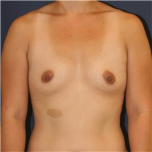Breast Augmentation Before Photo by Steve Laverson, MD, FACS; Rancho Santa Fe, CA - Case 44621