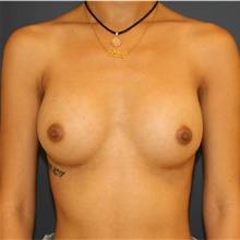 Breast Augmentation After Photo by Steve Laverson, MD, FACS; Rancho Santa Fe, CA - Case 44625