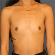Breast Augmentation Before Photo by Steve Laverson, MD, FACS; San Diego, CA - Case 44625