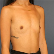Breast Augmentation Before Photo by Steve Laverson, MD, FACS; Rancho Santa Fe, CA - Case 44625