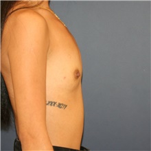 Breast Augmentation Before Photo by Steve Laverson, MD, FACS; Rancho Santa Fe, CA - Case 44625