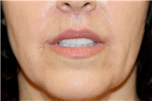 Lip Augmentation/Enhancement After Photo by Steve Laverson, MD, FACS; Rancho Santa Fe, CA - Case 44643