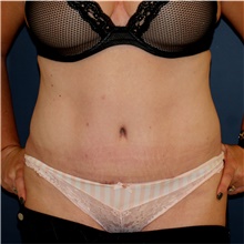 Tummy Tuck After Photo by Steve Laverson, MD, FACS; Rancho Santa Fe, CA - Case 44656