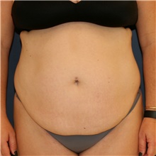 Tummy Tuck Before Photo by Steve Laverson, MD, FACS; Rancho Santa Fe, CA - Case 44656